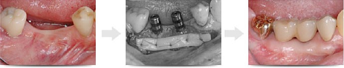 「見た目を修復」する歯肉移植手術
